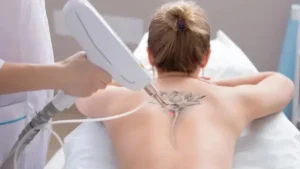 Why More People Are Choosing Laser Tattoo Removal in Vancouver