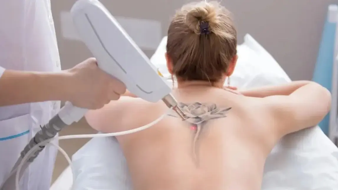 Why More People Are Choosing Laser Tattoo Removal in Vancouver