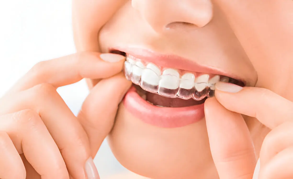 How Long Does Invisalign Treatment Take and How Does That Affect the Price?