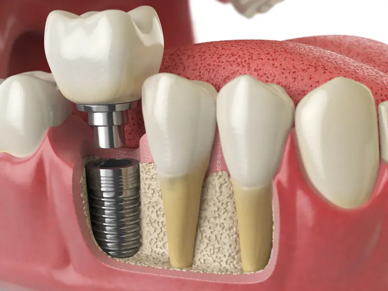Breaking Down the Dental Implant Procedure A Step-by-Step Guide