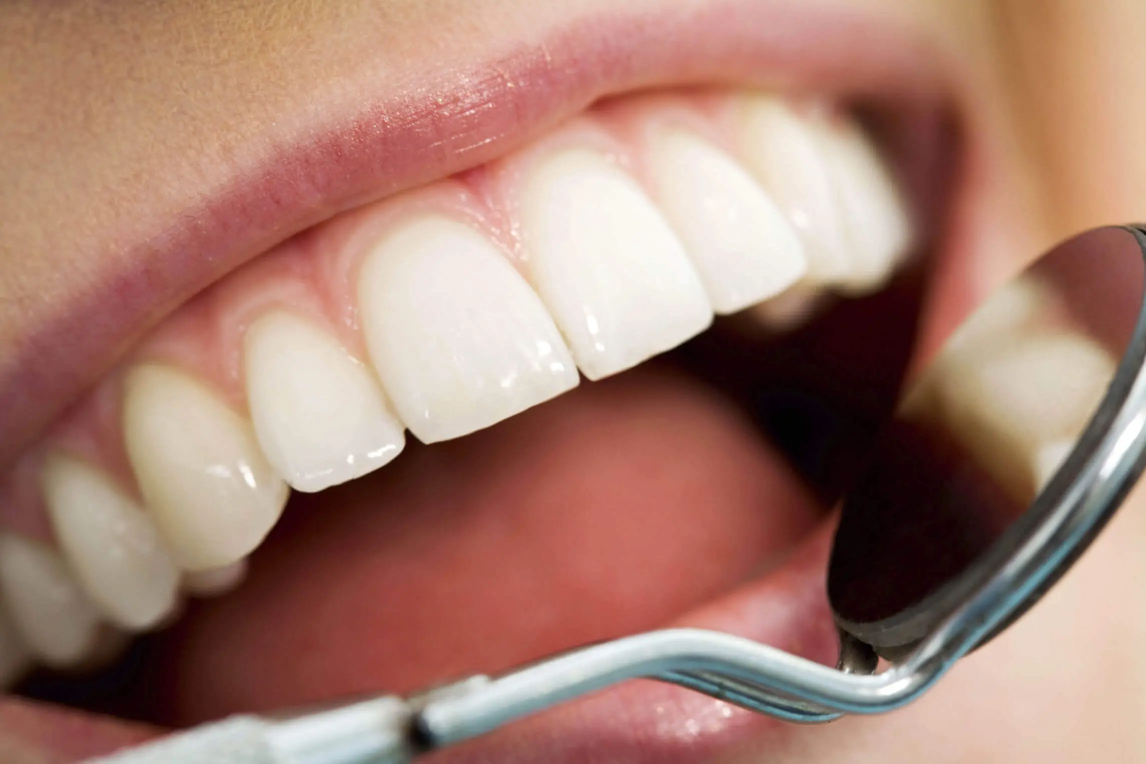 Why Preventive Care Protects The Investment Of Veneers, Crowns, And Whitening